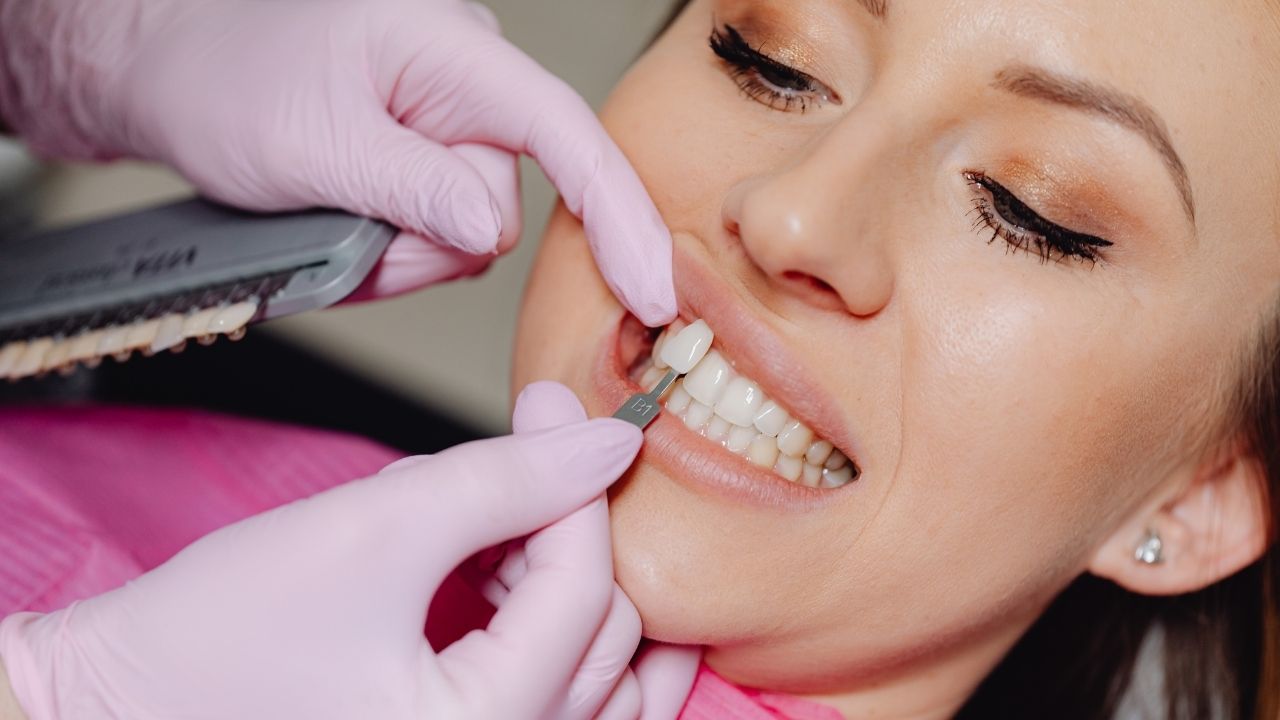 Dental Veneers